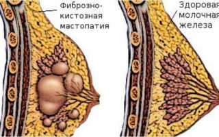 Лечение народными методами фиброзно-кистозной мастопатии
