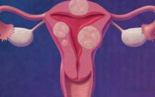 Причины, симптомы и лечение эндометриоза матки при климаксе