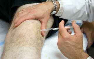 Внутрисуставные инъекции в коленный сустав: лучшие препараты