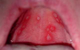 Стоматит у ребенка в горле: симптомы и лечение