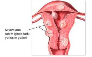 Особенности лечения миомы матки прополисом