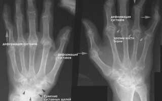 Чем эффективно лечить артрит кистей рук?
