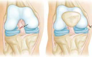 Разрыв передней крестообразной связки колена: причины, симптомы и методы лечения