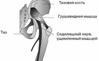 Защемление нерва в тазобедренном суставе: причины, симптомы и лечение ущемления
