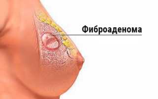 Признаки и лечение фиброаденомы груди