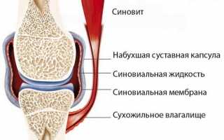 Синовит коленного сустава: симптомы, лечение, полное описание заболевания