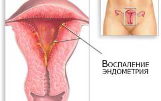 Способы домашнего лечения эндометриоза матки