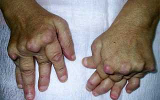 Серопозитивный ревматоидный артрит: что такое, симптомы и лечение