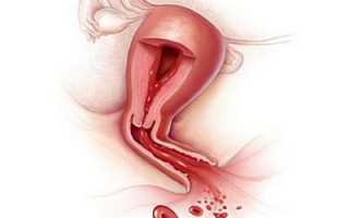 Что такое эндометрий и его функции перед месячными