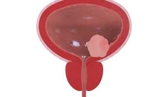 Виды, причины и лечение гематурии мочевого пузыря