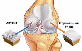 Артроз коленного сустава: лечение в домашних условиях, как лечить недуг