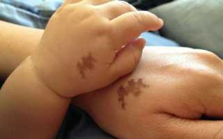 Причины появления коричневых пятен у ребенка и их особенности