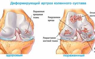 Деформирующий артроз коленного сустава 1, 2, 3 степени: причины, симптомы, лечение