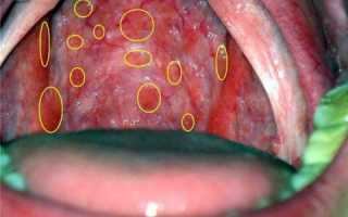 Фолликулы в горле и их важная функция в организме. Какие болезни вызывают воспаление фолликул?