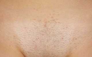 Причины, симптомы и лечение аллергии на половых губах