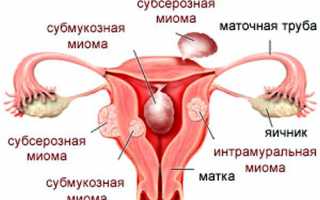 Причины, симптомы и лечение миомы матки и кисты яичника
