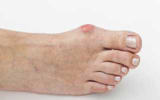 Болит косточка на ноге около большого пальца: лечение, причины и симптомы заболевания, как лечить недуг