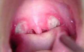 Белые прыщики в горле у ребенка: возможные причины появления и эффективное лечение