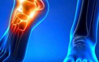 Тендовагинит голеностопного сустава: причины, диагностика и методы лечения
