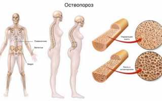 Какие препараты кальция использовать для профилактики остеопороза?