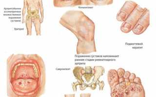 Причины и симптомы реактивного артрита у детей, методы лечения заболевания