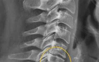 Симптомы и лечение остеохондроза шейно-плечевого отдела позвоночника