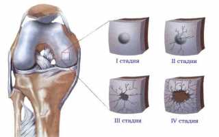 Гонартроз коленного сустава 1 степени: симптомы, диагностика и лечение заболевания