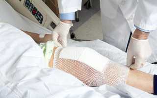 Правила реабилитации после эндопротезирования коленного сустава