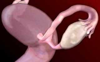 Возможные причины, осложнения и особенности лечения кисты на ножке яичника
