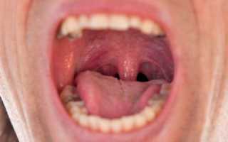 Болит горло слева при глотании и кашле