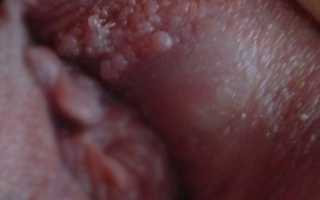 Причины, симптомы и лечение рака половых губ