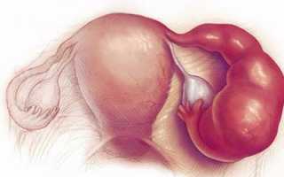 Признаки и возможные причины появления кисты яичника в менопаузе