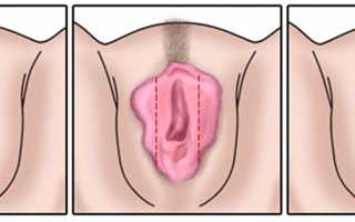 Операция по удалению половых губ. Подготовка и восстановление