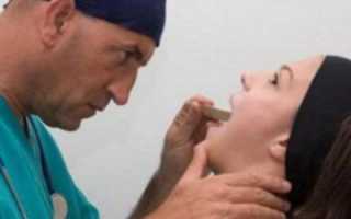 Гнойный абсцесс в горле — как он возникает и в чем заключается лечение