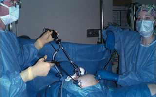 Показания к проведению операции лапароскопии печени