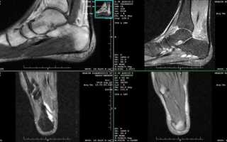 Визуализирующие возможности МРТ голеностопного сустава и стопы