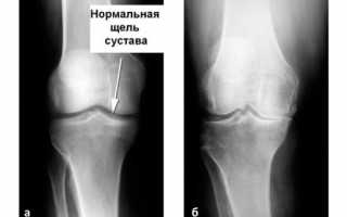 Боль в коленном суставе: причины, лечение, почему болят колени, что с этим делать, как и чем их лечить