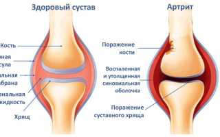 Как лечить воспаление коленного сустава