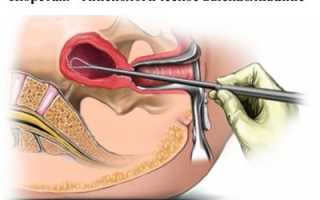 Этапы дагностического выскабливания полости матки при гиперплазии эндометрия