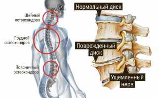 Гимнастика при остеохондрозе шейного-грудного отдела позвоночника