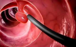 Основные этапы удаления полипа эндометрия. Особенности лечения патологии