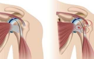 Эпикондилит плечевого сустава: причины, виды, диагностика и способы лечения