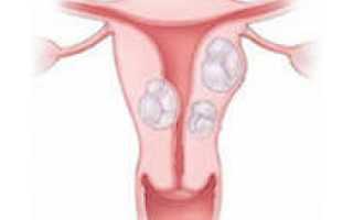 Особенности и роль фолиевой кислоты при миоме матки