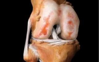 Симптомы и лечение артрита коленного сустава — полное описание и особенности заболевания