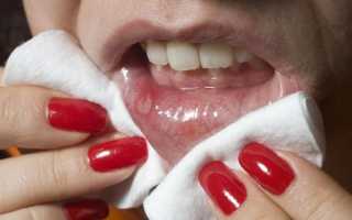 Симптомы и причины молочницы рта, специфика лечения