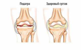 Что такое подагра коленного сустава: симптомы болезни, как и чем лечить