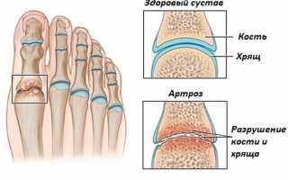 Что такое артроз стопы — симптомы и лечение, причины, как лечить заболевание ног