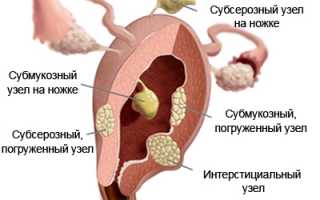 Возможные причины, симптомы и лечение интрамурально-субсерозной миомы матки
