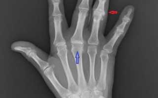 Как лечить полиартрит пальцев рук народными средствами?