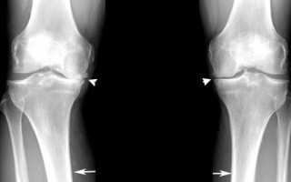 Восстановление хрящевой ткани коленного сустава: возможно или нет